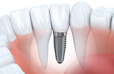 Implant Dentistry